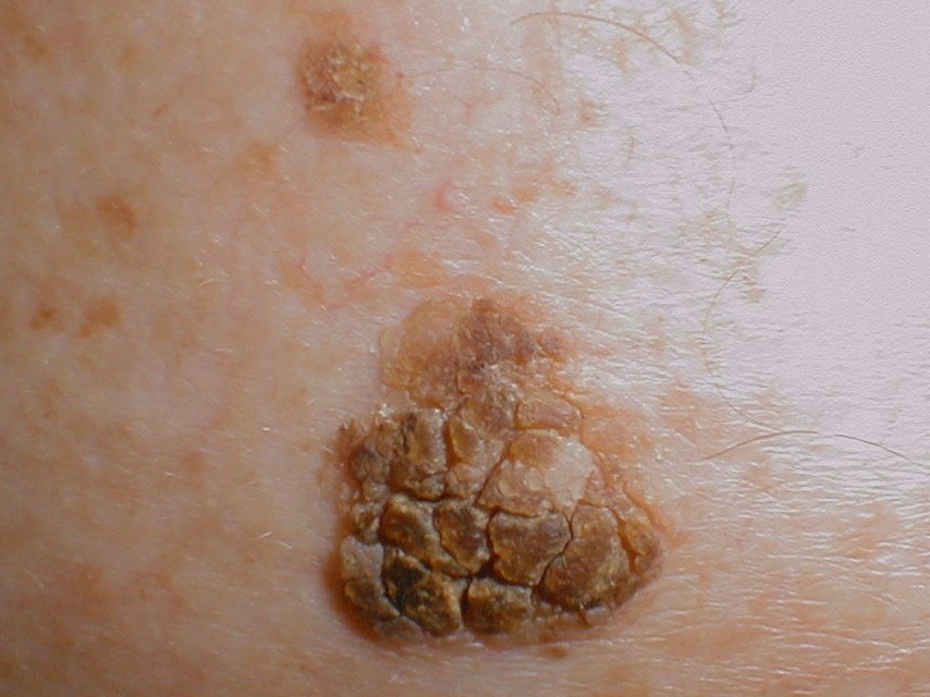 Dark Scaly Spots On Skin Skin Cancer Prevention Fraser Medical Clinic
