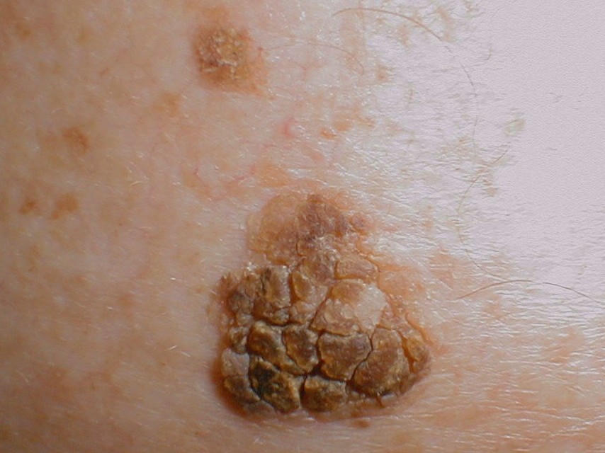 Light Brown Scaly Spots On Skin 