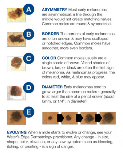 cancerous moles vs normal moles